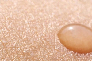 pickel im gesicht im urlaub